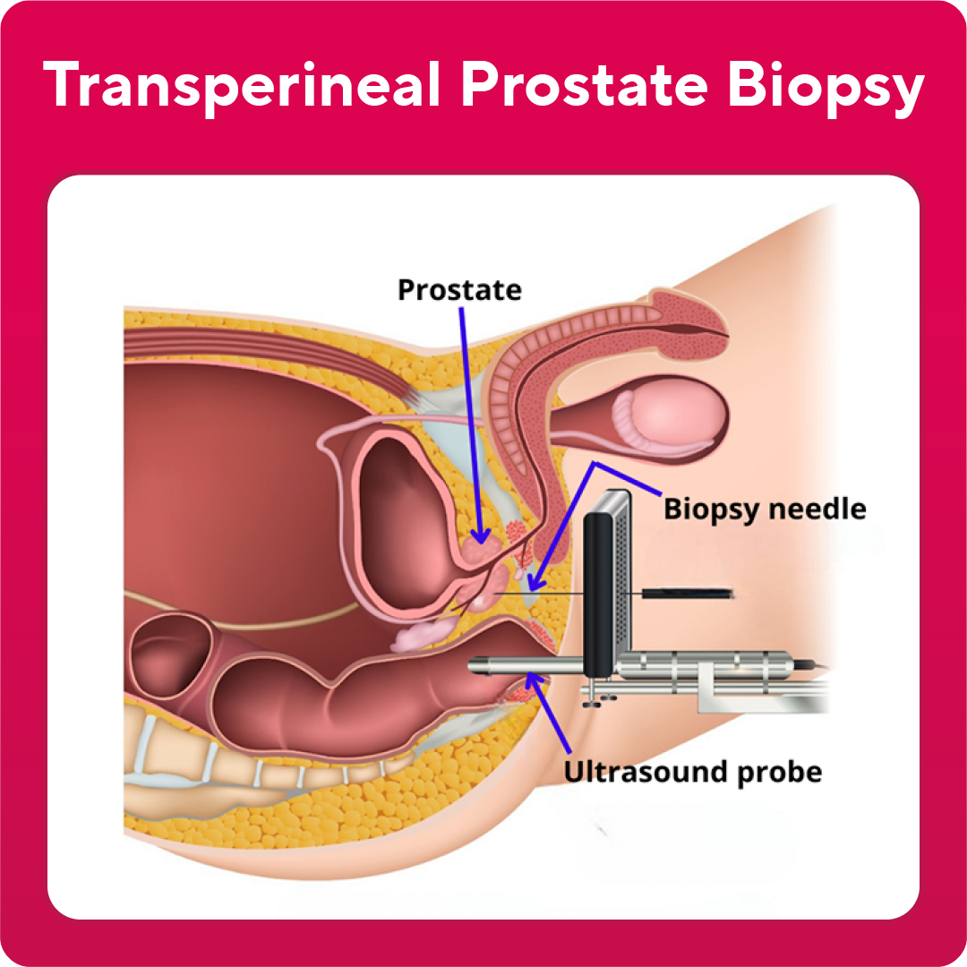 Transperineal Prostate Biopsy illustration